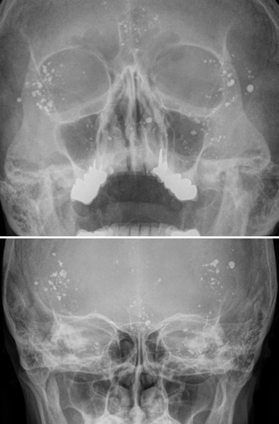 Figure 4 for case Lipiodol droplets after myelogram